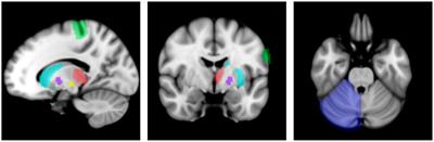 Motor network dynamic resting state fMRI connectivity of neurotypical children in regions affected by cerebral palsy